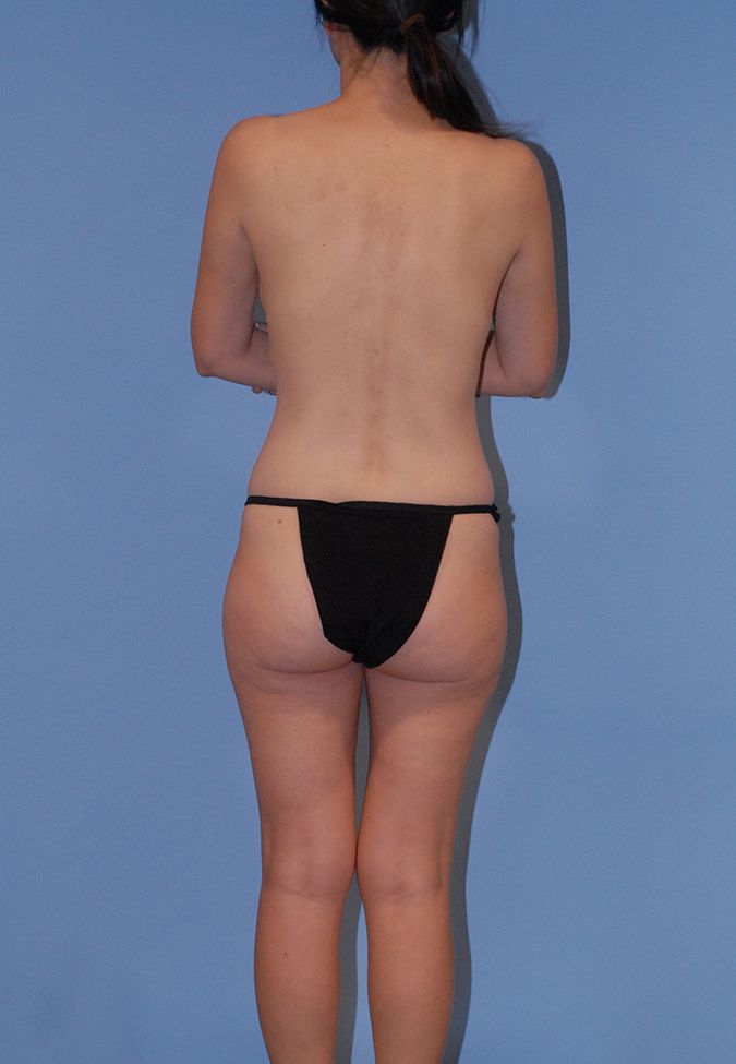 Liposuction Before & After Image