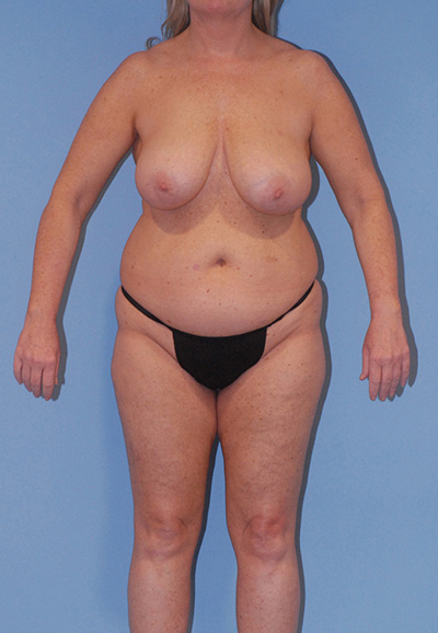 Liposuction Before & After Image