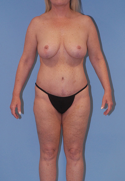 Liposuction Before & After Image