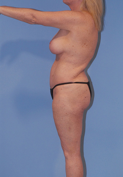 Liposuction Before & After Image
