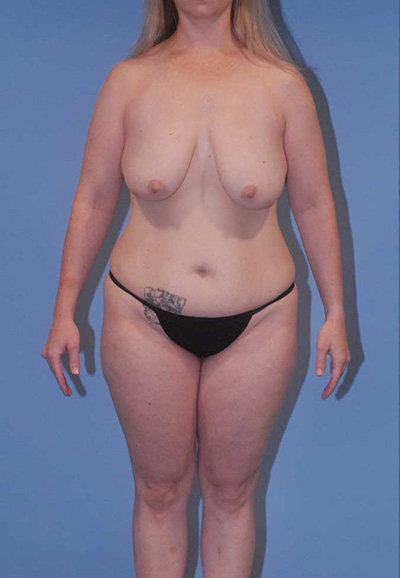 Liposuction Before & After Image