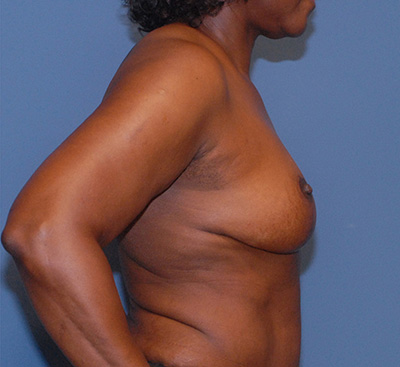 Liposuction Before & After Image