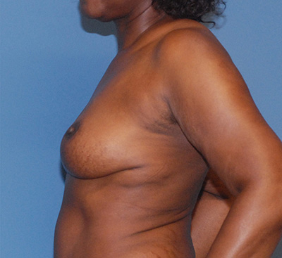 Liposuction Before & After Image