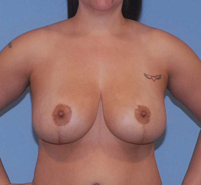 Liposuction Before & After Image