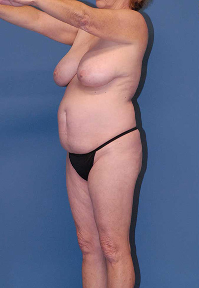 Liposuction Before & After Image