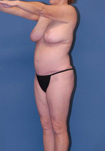 Liposuction Before & After Image
