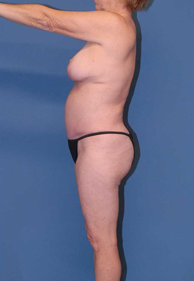 Liposuction Before & After Image