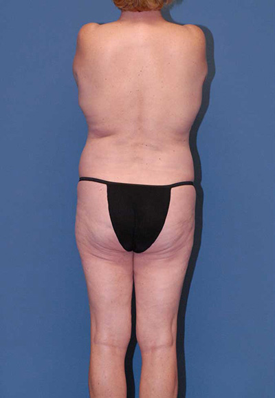 Liposuction Before & After Image