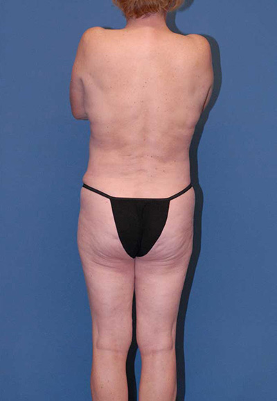 Liposuction Before & After Image
