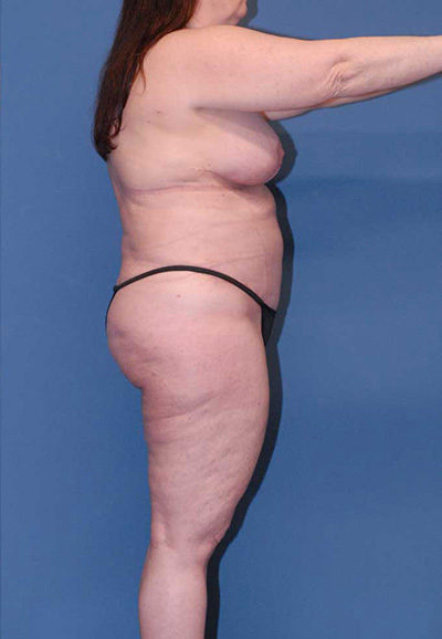 Liposuction Before & After Image