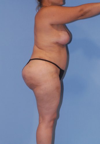 Liposuction Before & After Image