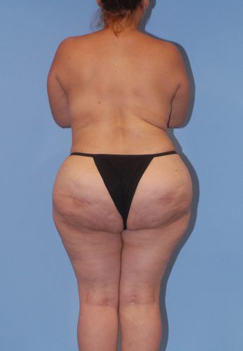 Liposuction Before & After Image
