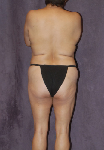 Liposuction Before & After Image