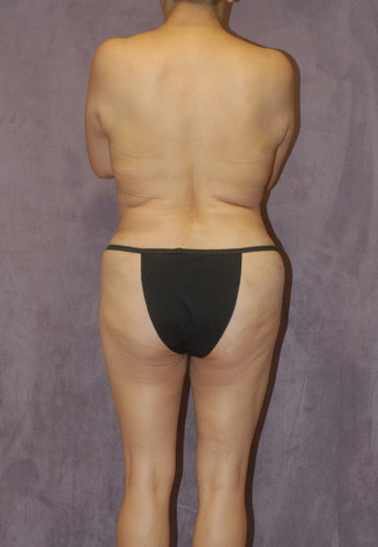 Liposuction Before & After Image