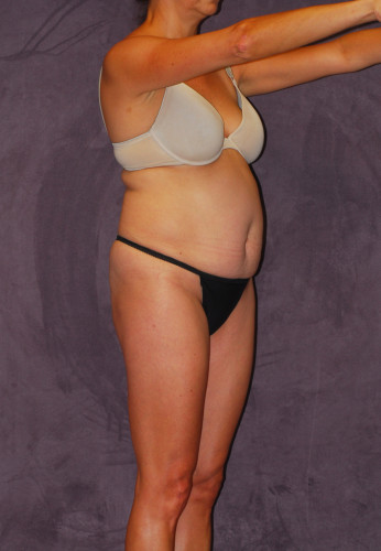 Liposuction Before & After Image