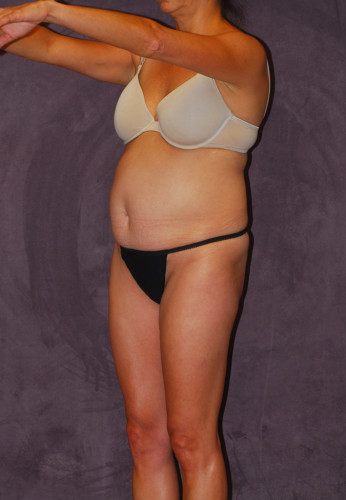 Liposuction Before & After Image