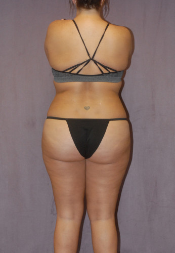 Liposuction Before & After Image