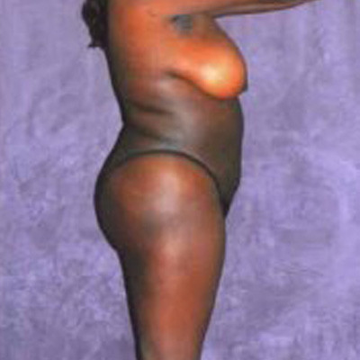 Liposuction Before & After Image
