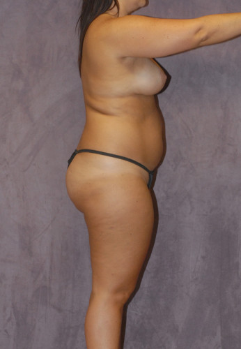Liposuction Before & After Image