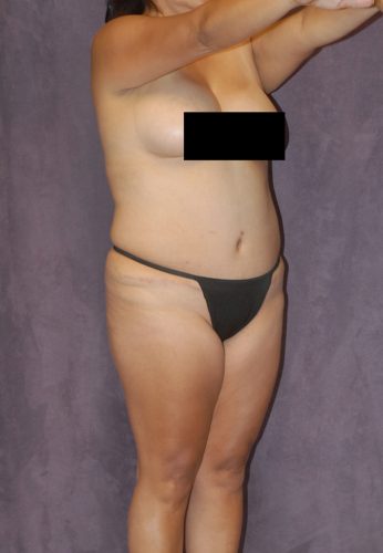 Liposuction Before & After Image