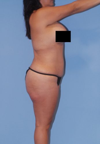 Liposuction Before & After Image