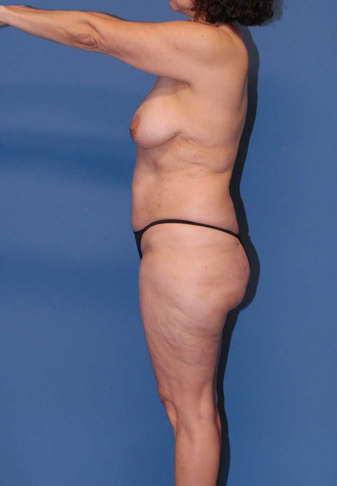 Lower Body Lift & Back Lift Before & After Image