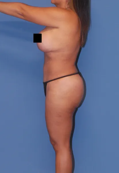 Mommy Makeover Before & After Image