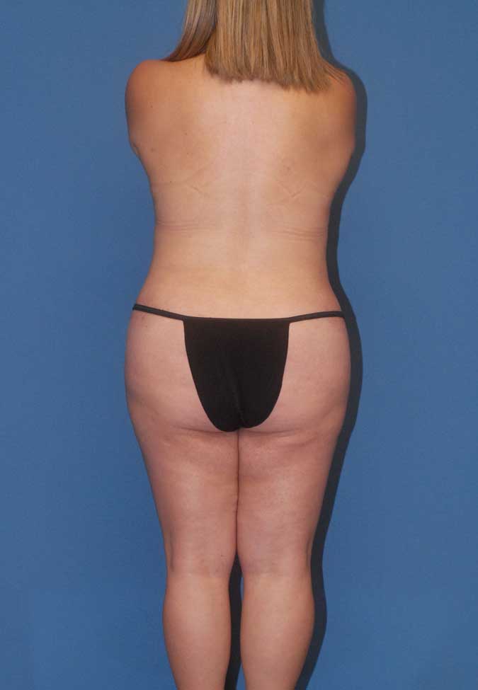 Mommy Makeover Before & After Image