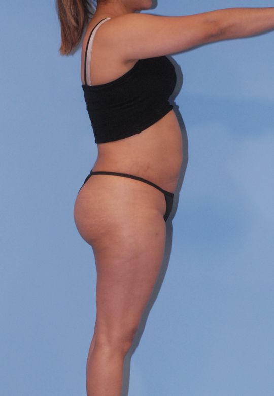 Mommy Makeover Before & After Image