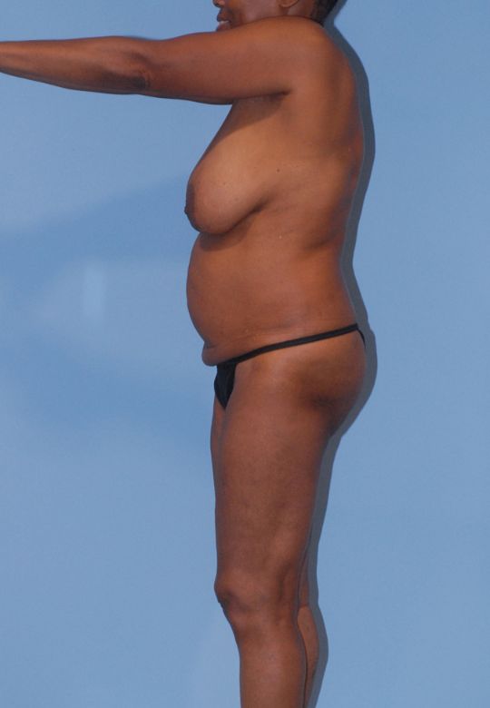 Mommy Makeover Before & After Image