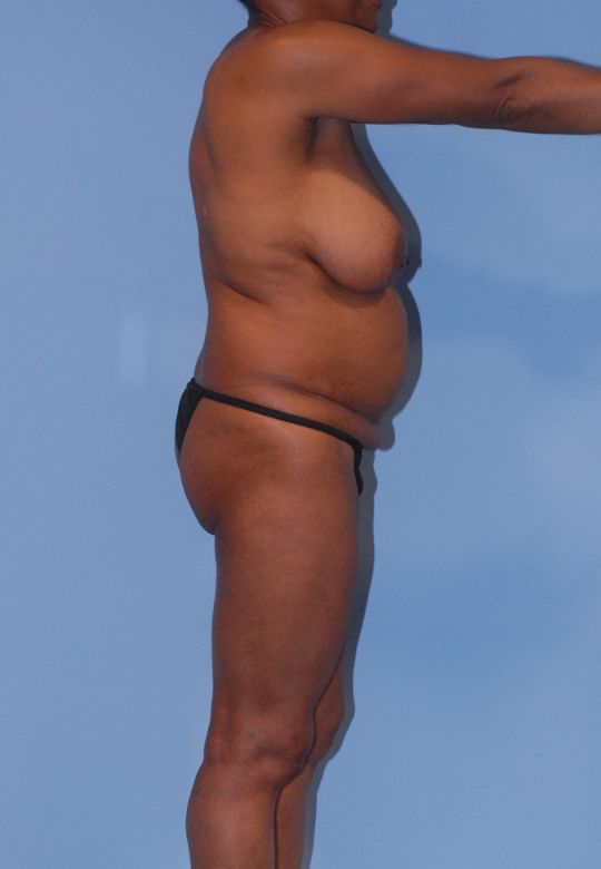 Mommy Makeover Before & After Image