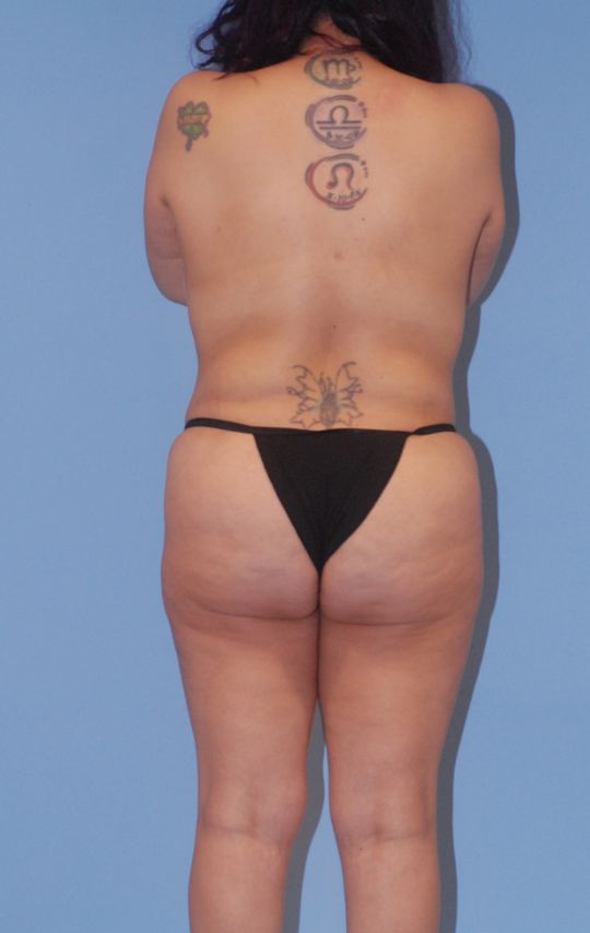 Mommy Makeover Before & After Image