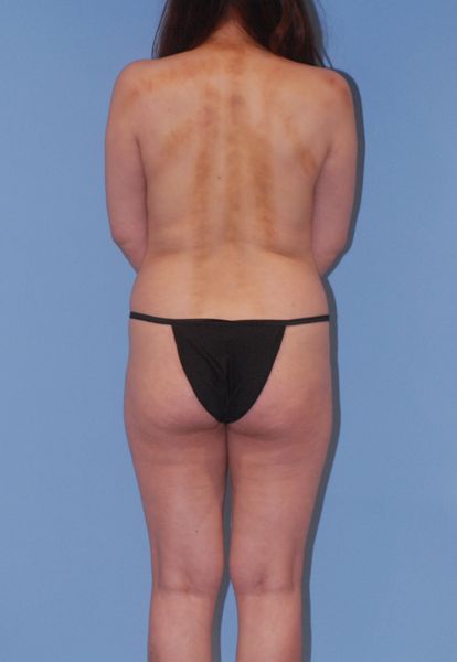 Mommy Makeover Before & After Image