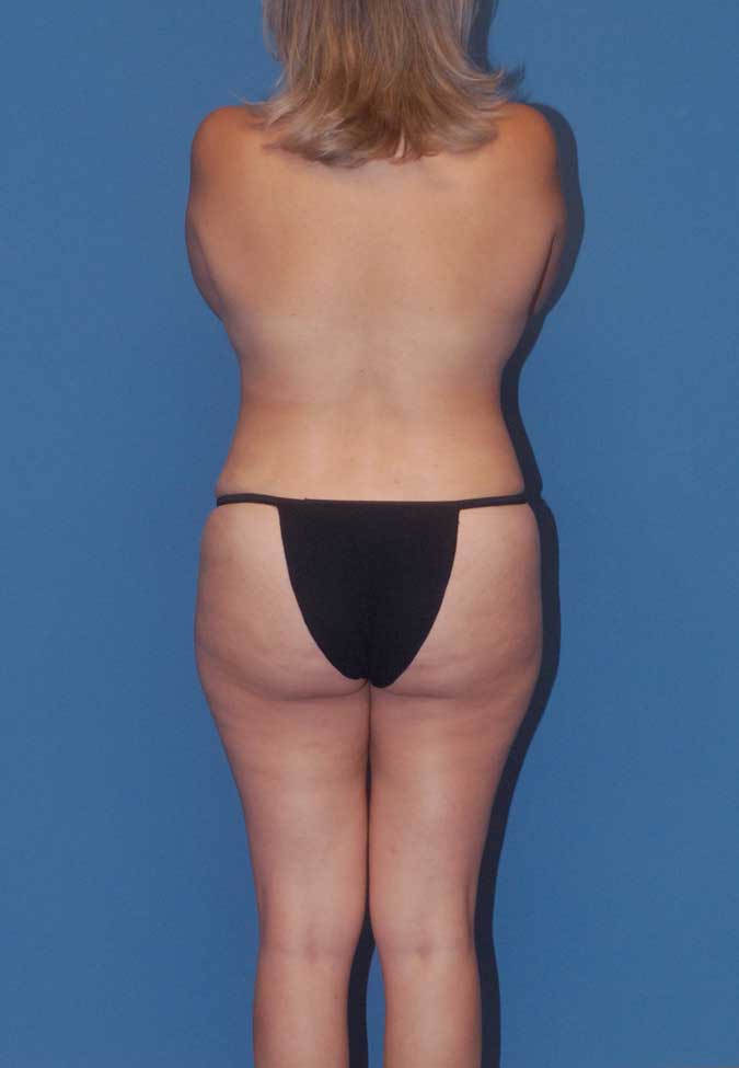 Mommy Makeover Before & After Image