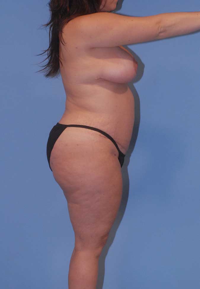 Mommy Makeover Before & After Image