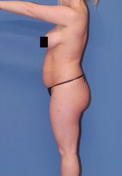 Mommy Makeover Before & After Image