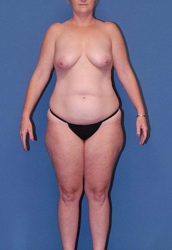 Mommy Makeover Before & After Image