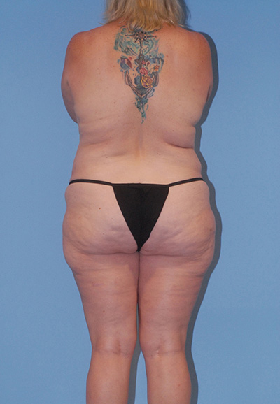 Mommy Makeover Before & After Image