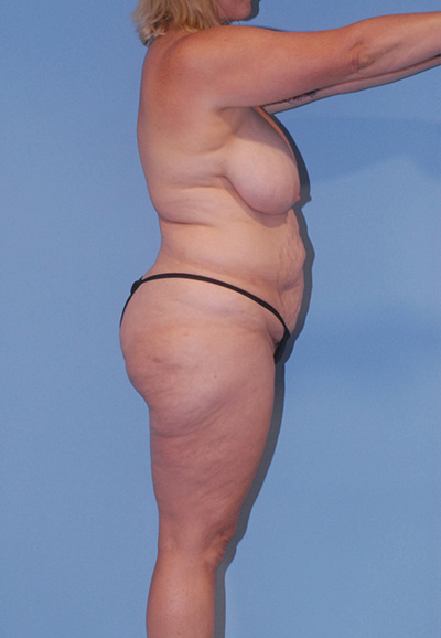 Mommy Makeover Before & After Image
