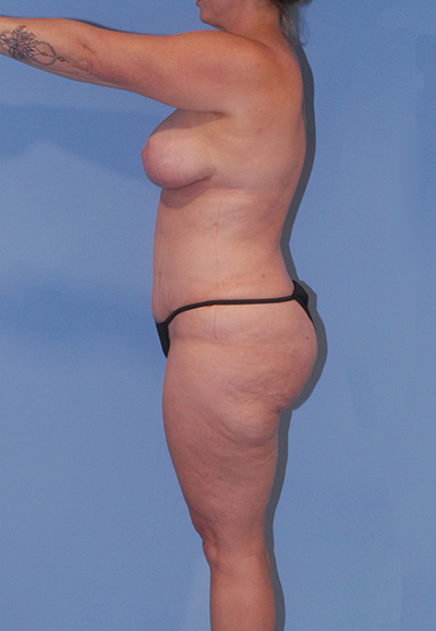 Mommy Makeover Before & After Image