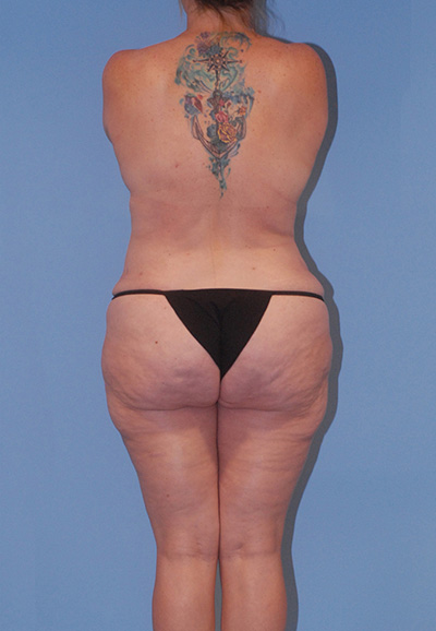 Mommy Makeover Before & After Image
