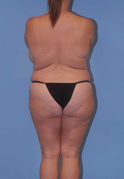 Mommy Makeover Before & After Image