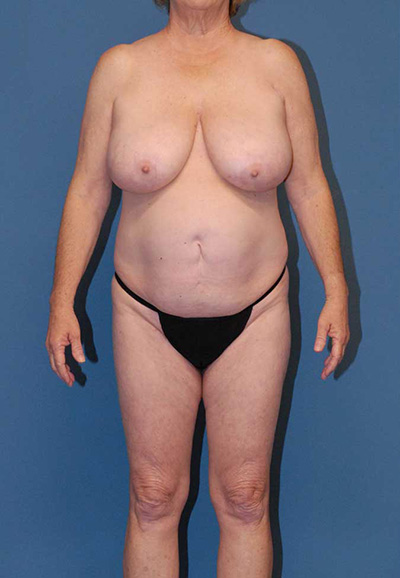 Mommy Makeover Before & After Image