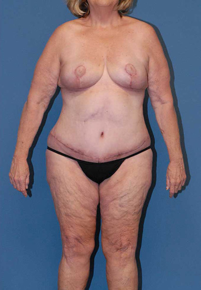 Mommy Makeover Before & After Image