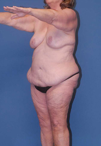 Mommy Makeover Before & After Image