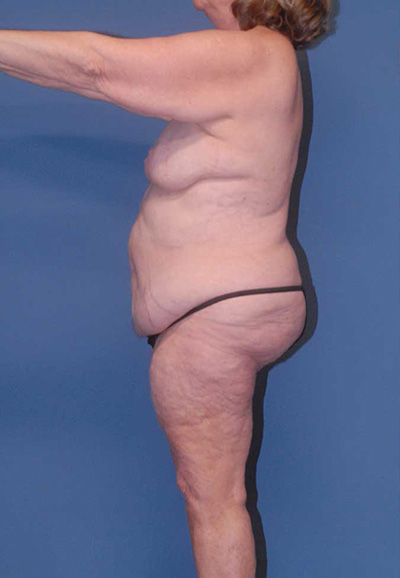 Mommy Makeover Before & After Image