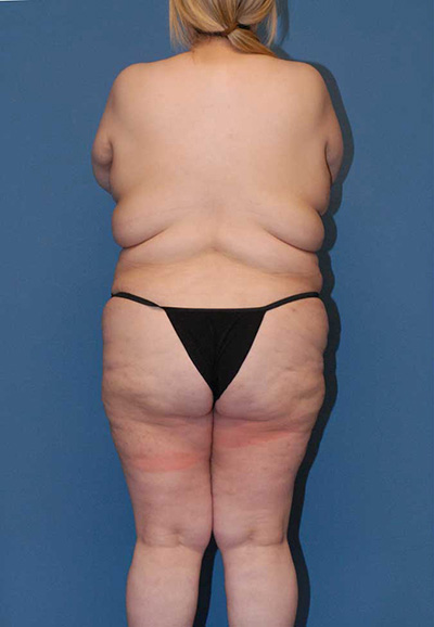 Mommy Makeover Before & After Image