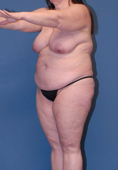Mommy Makeover Before & After Image