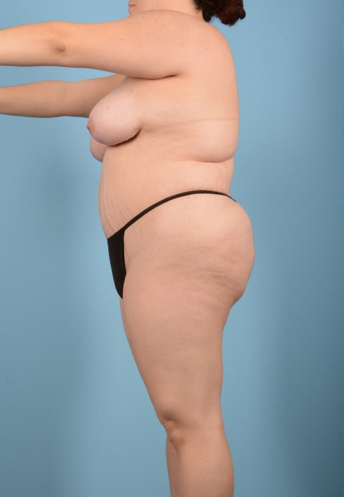 Thigh Lift Before & After Image