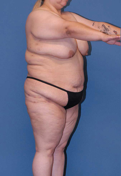 Torsoplasty (Upper Body Lift) Before & After Image